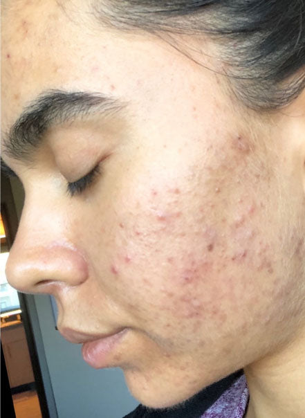 Acne Expert Testimonial